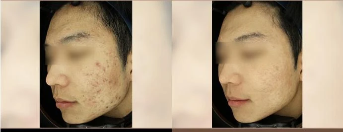 痘肌痘印
